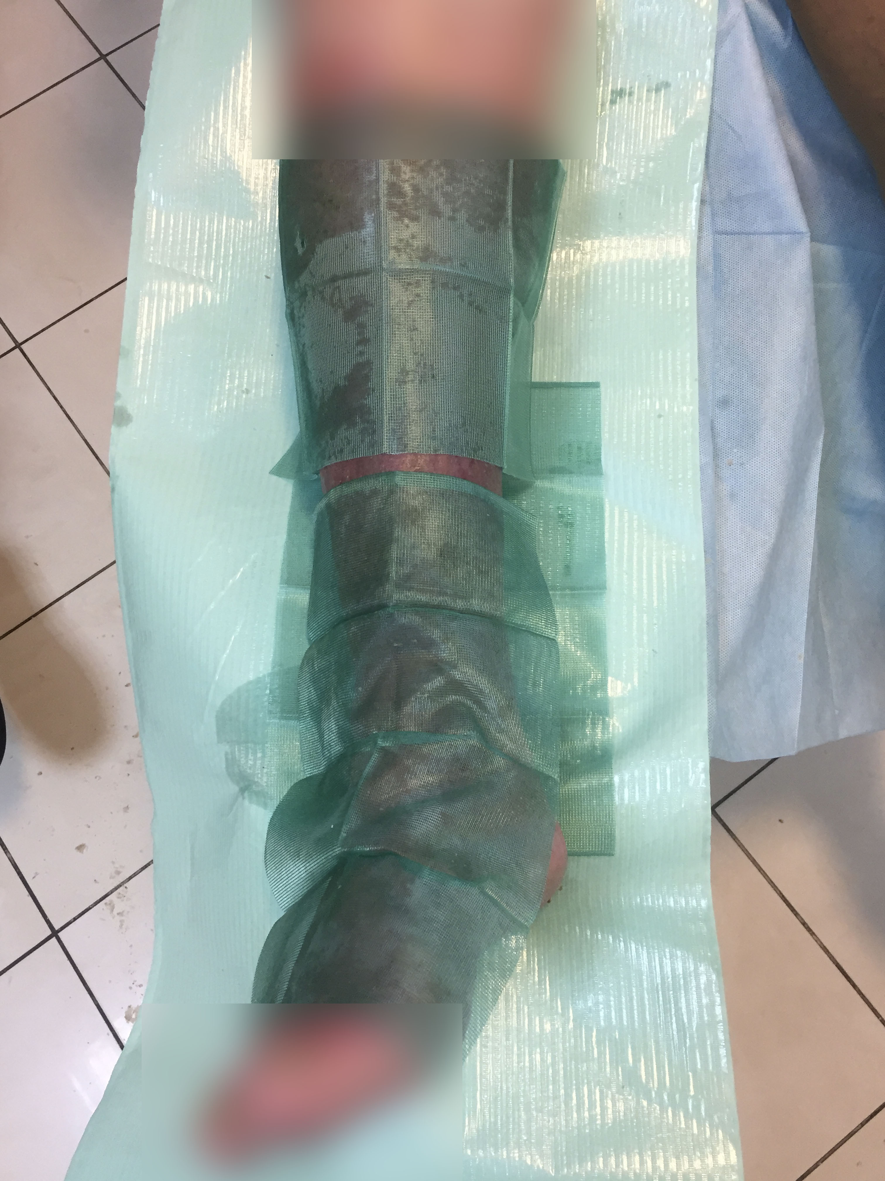 Limfologia przypadek 6