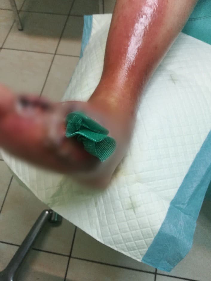 Przypadek podologiczny 4